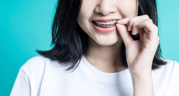 Dental Braces Adelaide From Consultation to Completion – What to Expect
