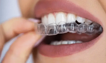 Invisalign Adelaide