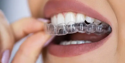 Invisalign Adelaide- The Step-by-Step Journey and What to Expect